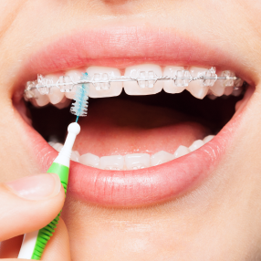 appareils dentaires adultes ceramique grenoble Brossage Cabinet d’orthodontie Drs. ROCCA & Associés