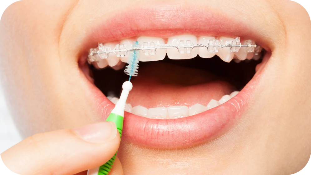 appareils dentaires adultes grenoble Appareils dentaires Cabinet d’orthodontie Drs. ROCCA & Associés