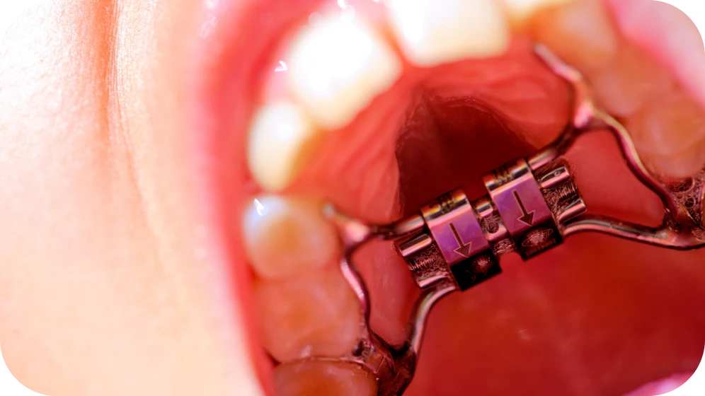 traitement disjoncteur maxillaire grenoble Disjoncteur Cabinet d’orthodontie Drs. ROCCA & Associés